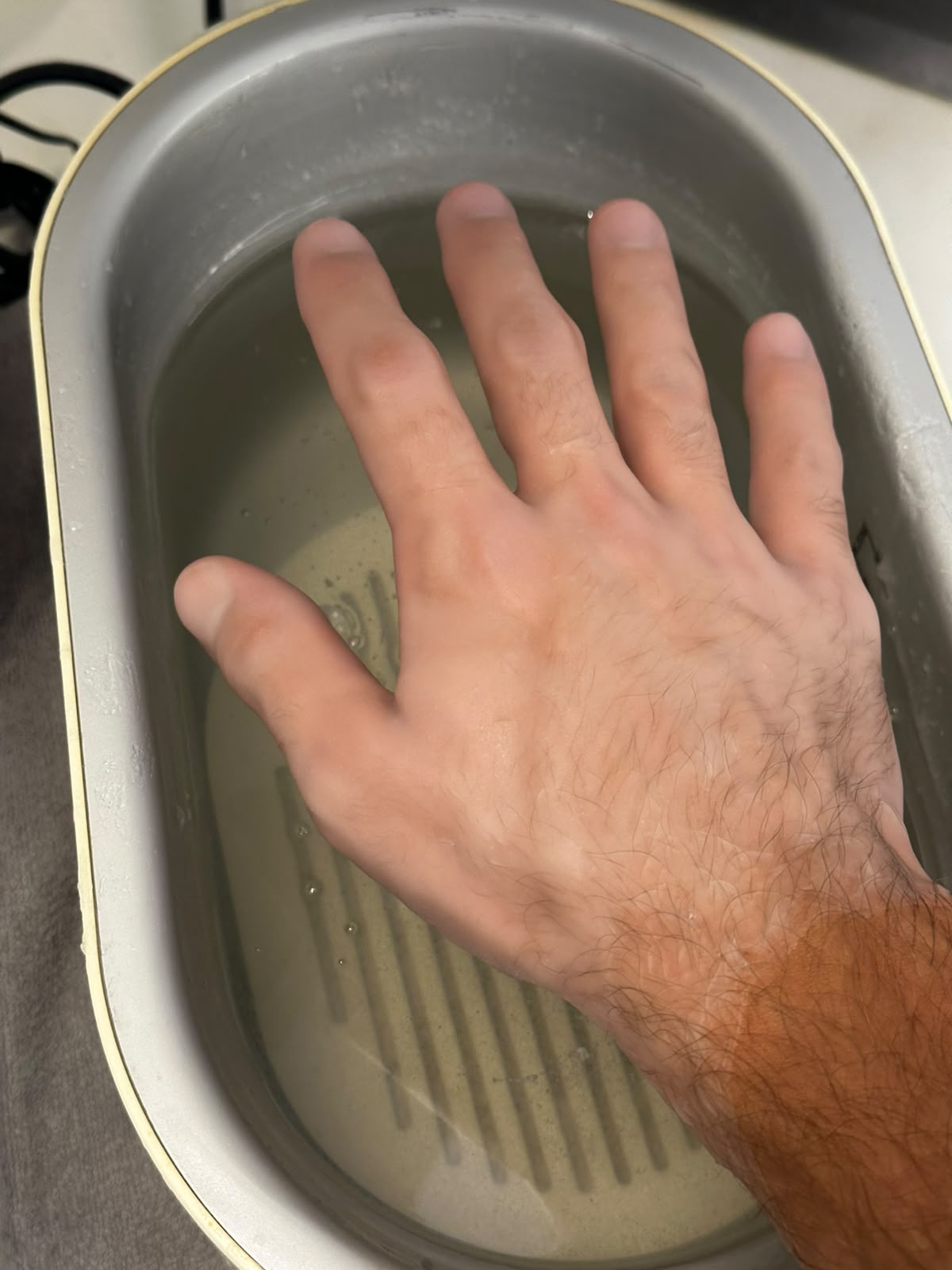 Trattamento con paraffina calda sulla mano di un paziente
